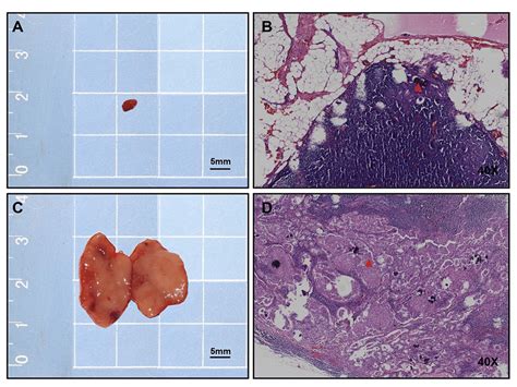 Positive Lymph Nodes Lns In Histological And Gross Specimens A