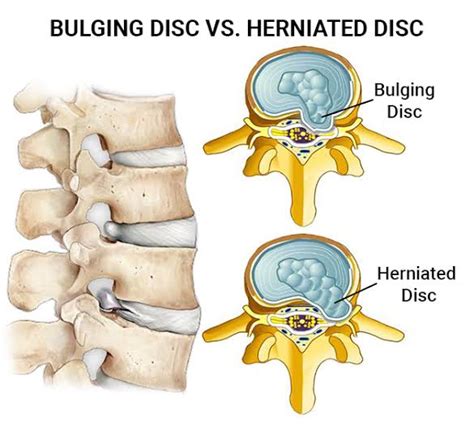 Disc Herniation Vs Disc Bulge Whats The Difference Health Hub