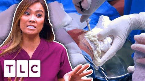 Drlee Pops The Biggest Cyst She Has Ever Seen Dr Pimple Popper Uncensored 18 Youtube