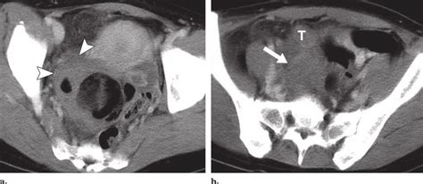 Torsion Of A Mature Cystic Teratoma In A Year Old Woman A Axial