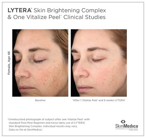 Vitalize peel® is appropriate for all skin types. Chemical Peel Series: What They Are and Why You Need One