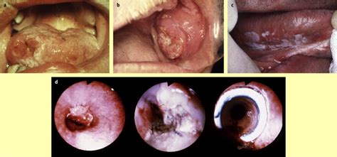 Squamous Cell Carcinoma Of The Oral Cavity Oropharynx And