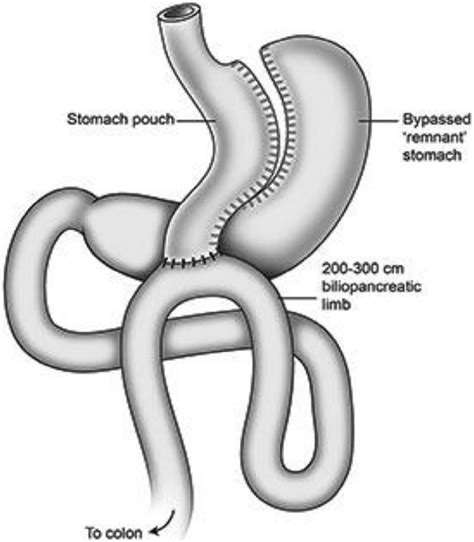 Omega Loop Mini Gastric Bypass Download Scientific Diagram