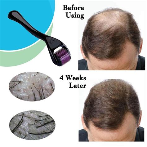 If you are using the dermaroller for diffuse hair loss, then it is important to make sure hair does not get caught in the roller. Hair Regrowth Micro-Needling Derma Roller - Pama Goods