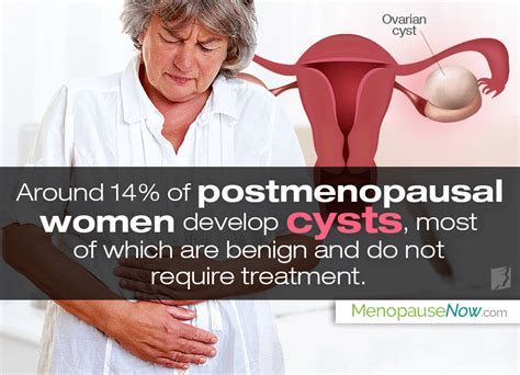 Are Ovarian Cysts Common After Menopause Menopause Now