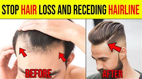 How To Stop Receding Hairline And Regrow Hair Naturally 310