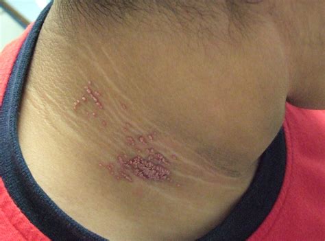 Acanthosis Nigricans Laser Treatment Pregnant Center Informations