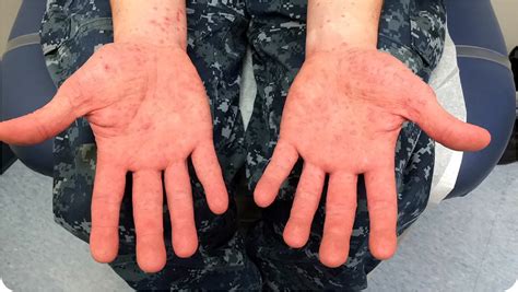 It typically begins with a fever and feeling generally unwell. Progressive Rash Involving the Hands and Feet - Photo Quiz ...