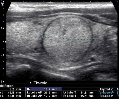 Thyroid Nodule Ultrasound