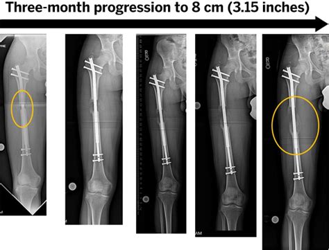 Limb Lengthening Surgery Hss Orthopedics Ranked 1 In Us