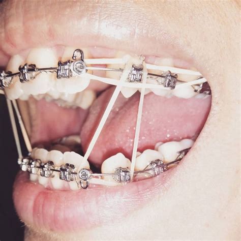 Awasome How Long Do You Have To Wear Braces To Fix An Overbite References