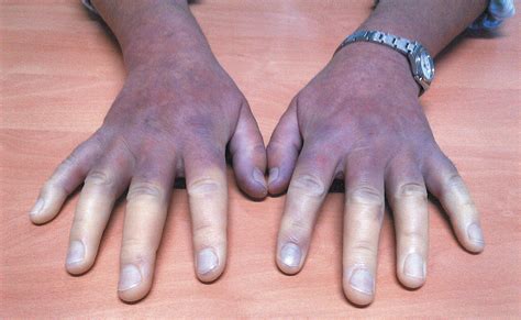 Cold Hands Associated With Scleroderma — Nejm