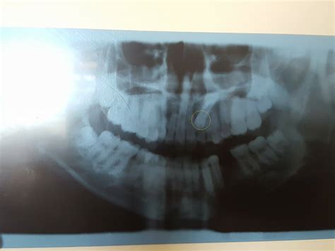CASE #91 - class III... - Smile Sanctuary Dental Clinic