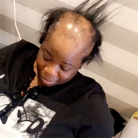 This Woman With Alopecia Just Got The Most Amazing Hair Transformation