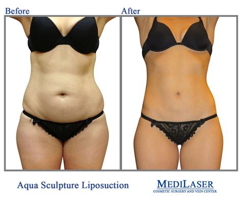 Liposuction Before And After Medilaser Surgery And Vein Center