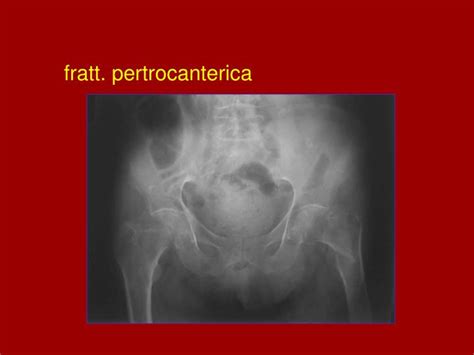 PPT - FRATTURE PROSSIMALI DEL FEMORE PowerPoint ...
