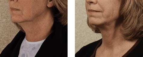 Neck Lift Options Which One Will Work Best For You