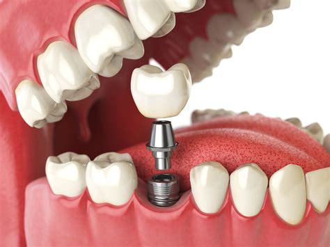 Dental Implant Surgery » Oral Surgery in St. Louis & Festus by St. Louis South Oral Surgery