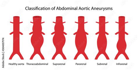 Vettoriale Stock Classification Of Abdominal Aortic Aneurysms Healthy