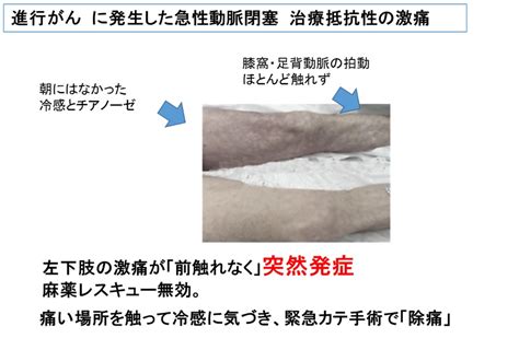 . 括家族中有直系親屬曾患大腸癌、有兄弟姊妹在未滿 60 歲時患有腺瘤息肉、 患有家族性大腸腺息肉病，以及帶有 遺傳性 非 息 肉 病 大 腸 癌的突發基因。 癌 痛み止め - Hello Doctor