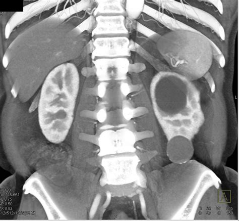 Bosniak 2f Cyst Lower Pole Left Kidney Kidney Case Studies Ctisus