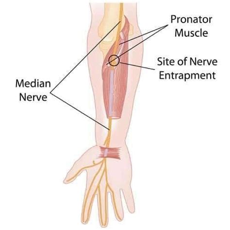 Chiropractic Evaluation Carpal Tunnel Vs Pronator Teres — Chiroup
