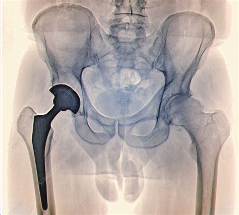 Total Hip Replacement X Ray Stock Image C0403279 Science Photo Library
