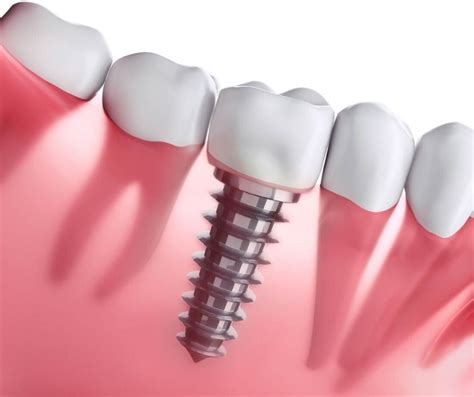 Implantes Dentales Que Son Y Por Que Los Necesitas Cl Nica Levante