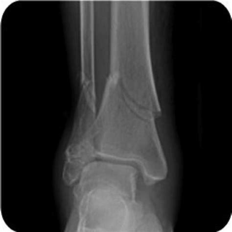 Left Tibial Plateau Fracture Icd 10 Code