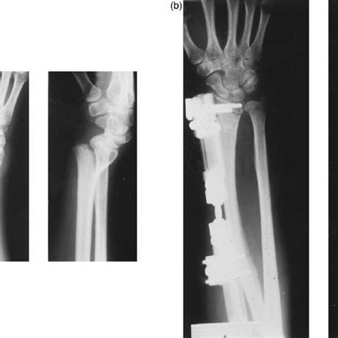A Unstable Metaphyseal Distal Radius Fracture In A 55 Year Old Female