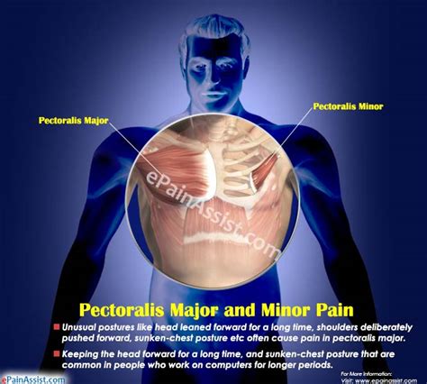 Pectoralis Major And Minor Paincausessymptomstreatmentrecovery