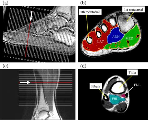 The first purpose of this study was to estimate in vivo the interpretations: MRI with user outlined plantar intrinsic and extrinsic muscles group. A... | Download Scientific ...