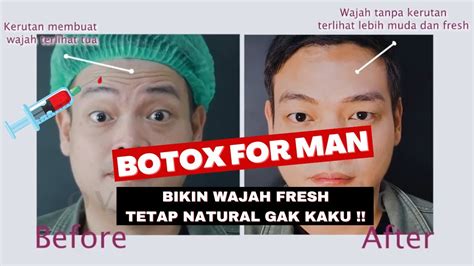 Suntik Botox Before And After For Man Hasil Nyata Bikin Awet Muda Ovela Clinic Youtube