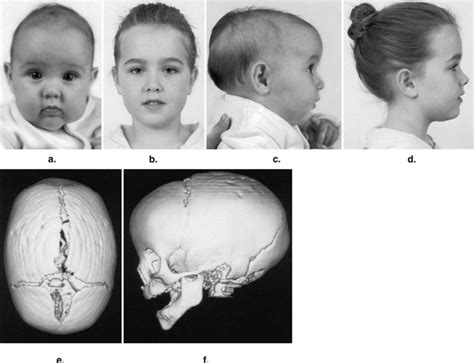 Nonsynostotic Scaphocephaly The So Called Sticky Sagittal Suture In