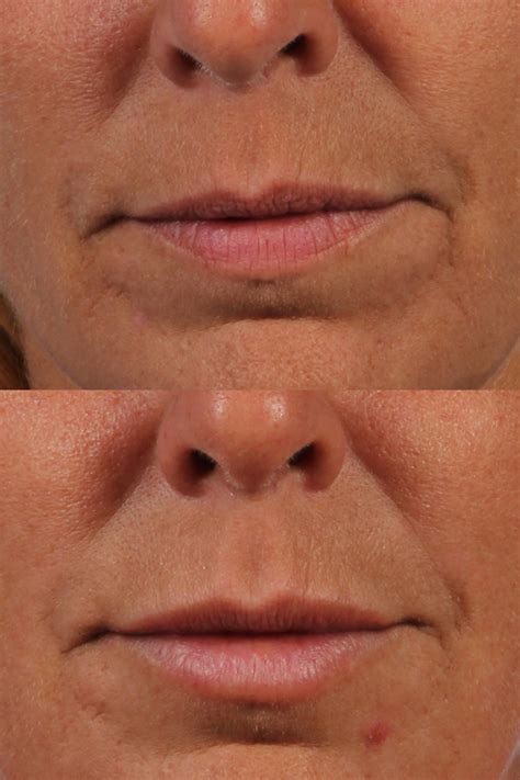 Lip Enhancement Dr Brett Kotlus Cosmetic Oculoplastic Surgeon Nyc