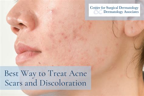 How To Best Treat Acne Scars And Discoloration For Smooth Clear Skin