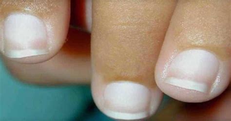 Terrys Nails Causes Differential Diagnosis And Treatment