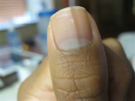 Black Line On Nail Pictures Photos