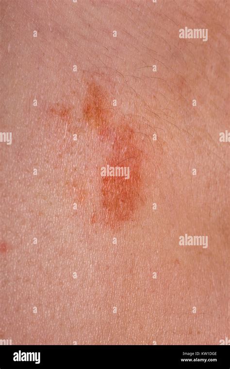 The Great Red Spot On The Skin Closeup Stock Photo Alamy