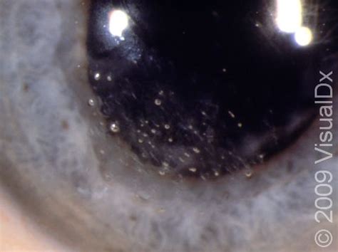 Recurrent Corneal Erosion Causes Symptoms And Treatment