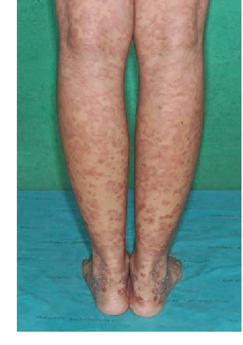 Figure 2 From Acral Pityriasis Rosea A Rare Variant Of Pityriasis
