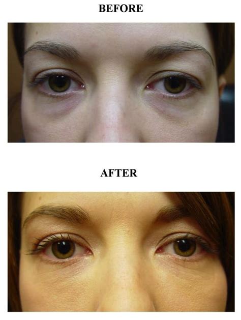 Before And After Fillers Tear Troughs Photos The Medical Spa