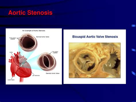 Ppt Pathology Of Rheumatic Fever Ie And Valvular Diseases Dr Ammar Al