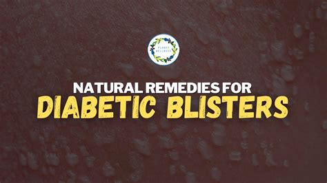 Natural Remedies For Diabetic Blisters Youtube