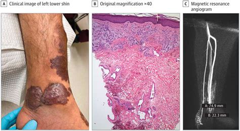 Violaceous Plaques On The Left Lower Extremity Dermatology Jama