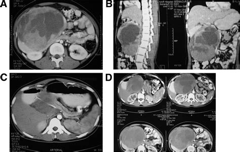 Large Retroperitoneal Mass In A Young Female Patient Gastroenterology