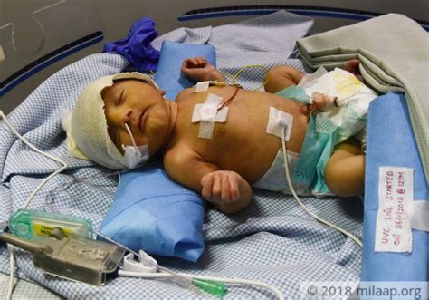 For This 16 Day Old Baby Girl Every Passing Minute Is A Risk Milaap