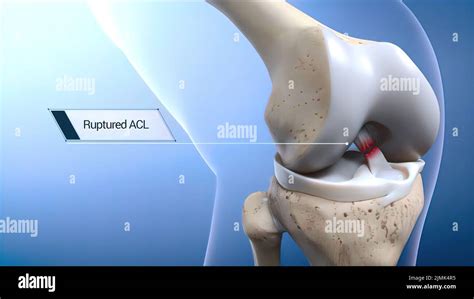Anterior Knee Ligament Sports Injury Hi Res Stock Photography And