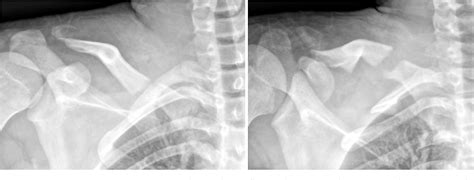 Figure 1 From Atypical Bipolar Segmental Fracture Of The Clavicle In An