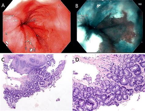 Endoscopic And Histological Images Of A Short Segment Barretts